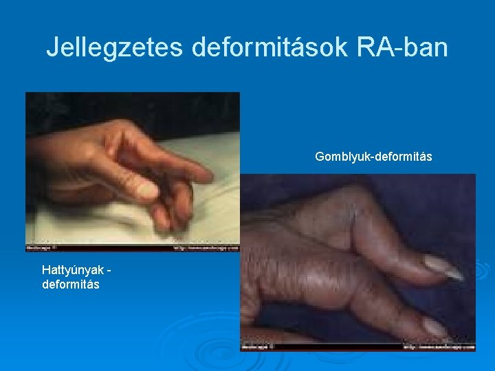 Jellegzetes deformitások RA-ban Gomblyuk-deformitás Hattyúnyak deformitás Jellegzetes deformitások RA-ban Gomblyuk-deformitás Hattyúnyak deformitás