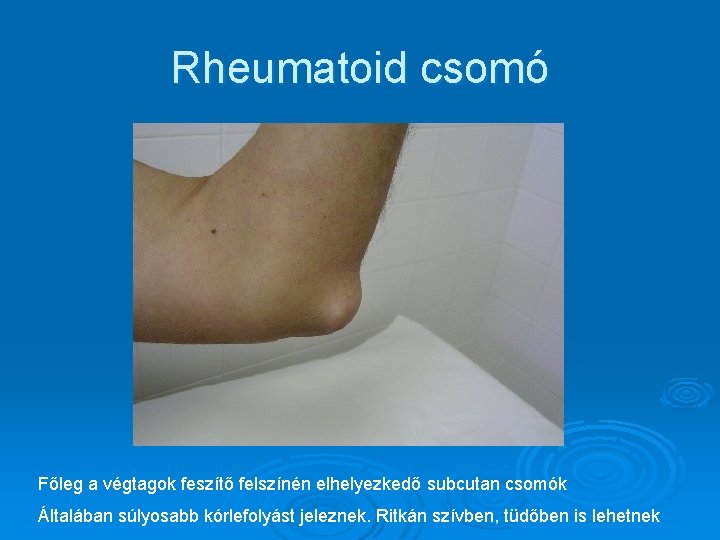 Rheumatoid csomó Főleg a végtagok feszítő felszínén elhelyezkedő subcutan csomók Általában súlyosabb kórlefolyást jeleznek. Rheumatoid csomó Főleg a végtagok feszítő felszínén elhelyezkedő subcutan csomók Általában súlyosabb kórlefolyást jeleznek.