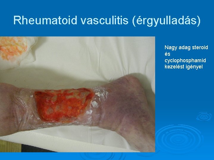 Rheumatoid vasculitis (érgyulladás) Nagy adag steroid és cyclophosphamid kezelést igényel Rheumatoid vasculitis (érgyulladás) Nagy adag steroid és cyclophosphamid kezelést igényel