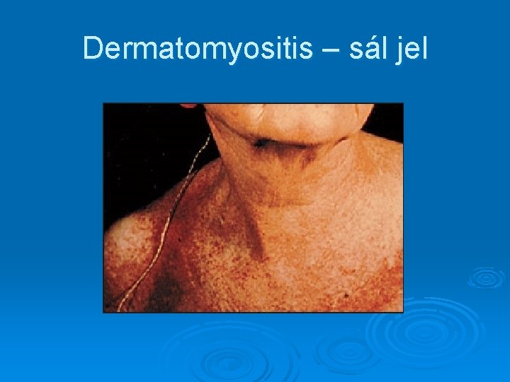 Dermatomyositis – sál jel Dermatomyositis – sál jel