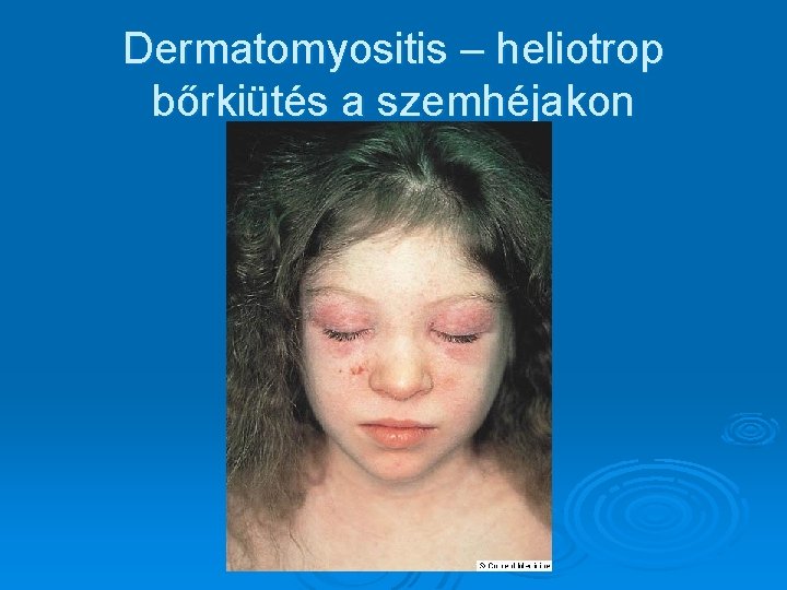 Dermatomyositis – heliotrop bőrkiütés a szemhéjakon Dermatomyositis – heliotrop bőrkiütés a szemhéjakon