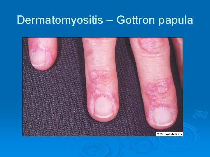 Dermatomyositis – Gottron papula Dermatomyositis – Gottron papula