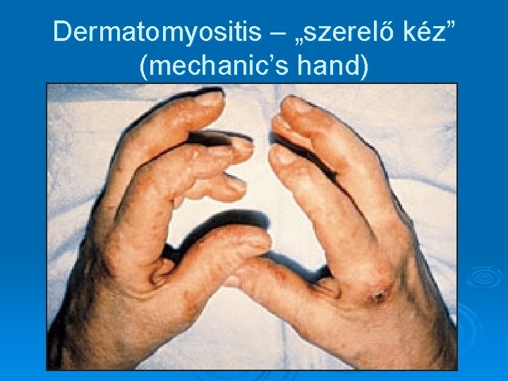 Dermatomyositis – „szerelő kéz” (mechanic’s hand) Dermatomyositis – „szerelő kéz” (mechanic’s hand)
