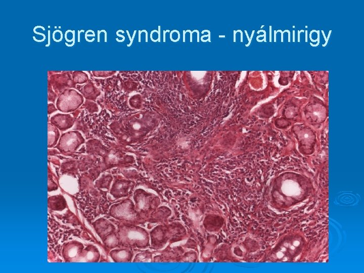 Sjögren syndroma - nyálmirigy Sjögren syndroma - nyálmirigy