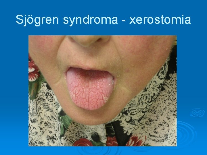 Sjögren syndroma - xerostomia Sjögren syndroma - xerostomia