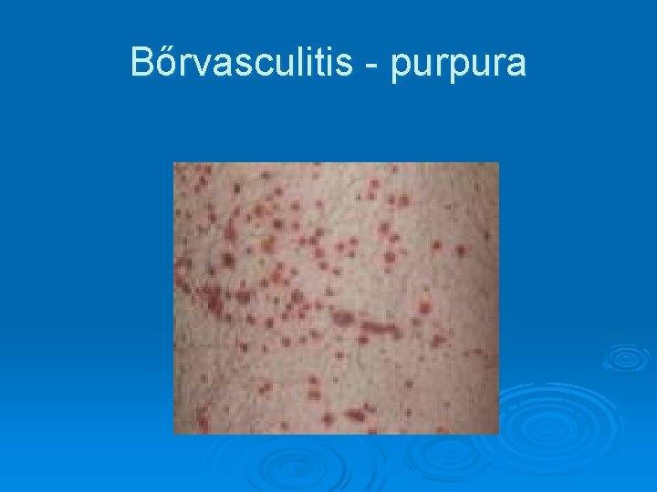 Bőrvasculitis - purpura Bőrvasculitis - purpura