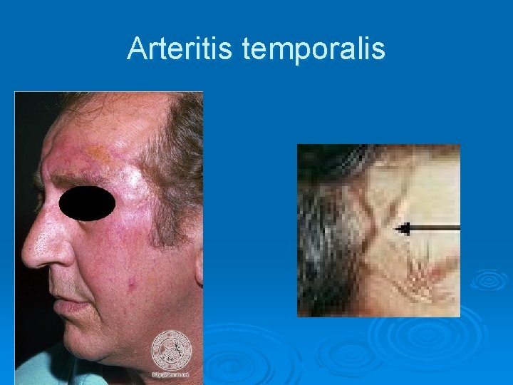 Arteritis temporalis Arteritis temporalis