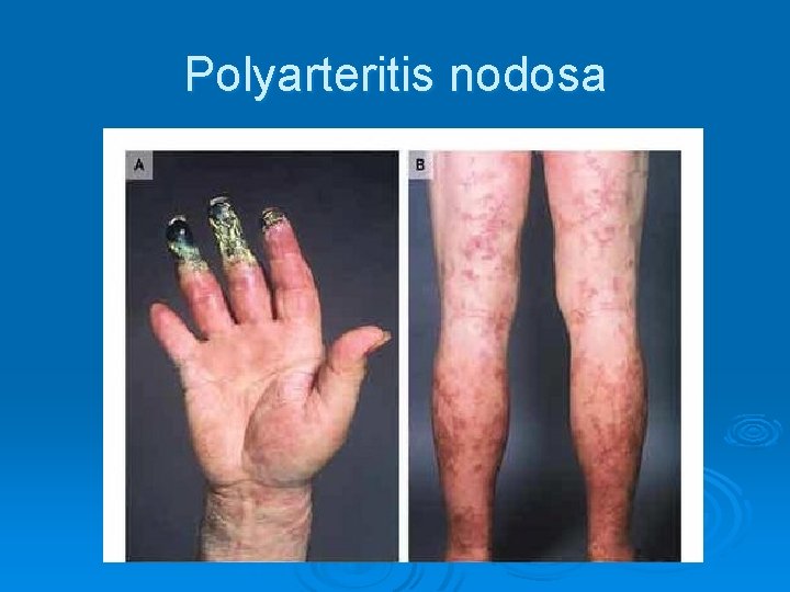 Polyarteritis nodosa Polyarteritis nodosa