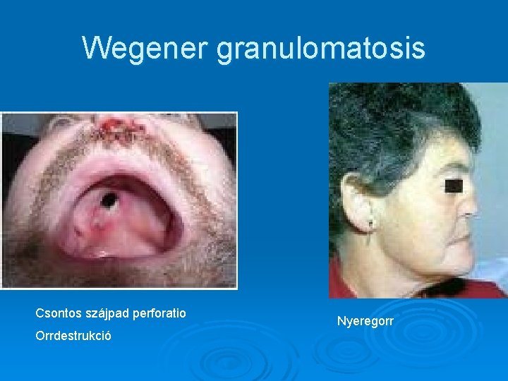Wegener granulomatosis Csontos szájpad perforatio Orrdestrukció Nyeregorr Wegener granulomatosis Csontos szájpad perforatio Orrdestrukció Nyeregorr