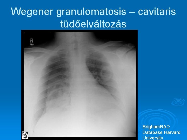 Wegener granulomatosis – cavitaris tüdőelváltozás Brigham. RAD Database Harvard University Wegener granulomatosis – cavitaris tüdőelváltozás Brigham. RAD Database Harvard University