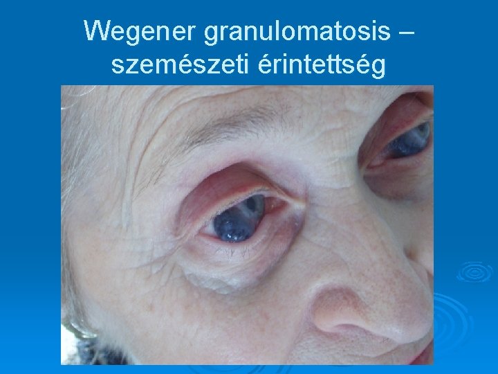 Wegener granulomatosis – szemészeti érintettség Wegener granulomatosis – szemészeti érintettség