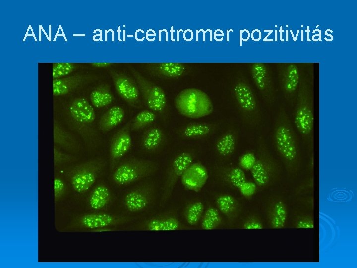 ANA – anti-centromer pozitivitás ANA – anti-centromer pozitivitás