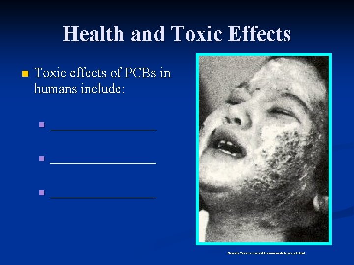 Health and Toxic Effects n Toxic effects of PCBs in humans include: n __________________