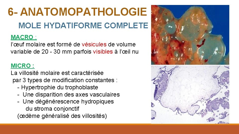 6 - ANATOMOPATHOLOGIE MOLE HYDATIFORME COMPLETE MACRO : l’œuf molaire est formé de vésicules