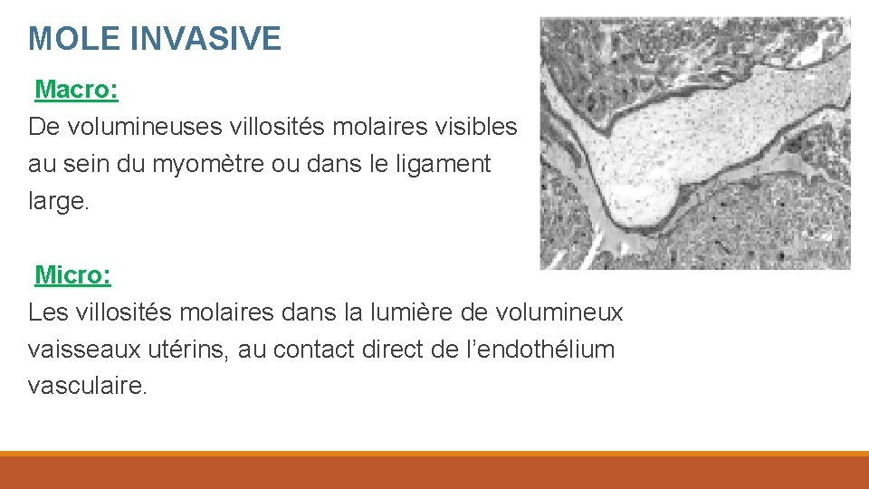 MOLE INVASIVE Macro: De volumineuses villosités molaires visibles au sein du myomètre ou dans