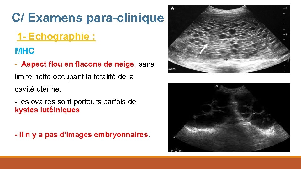 C/ Examens para-clinique 1 - Echographie : MHC - Aspect flou en flacons de