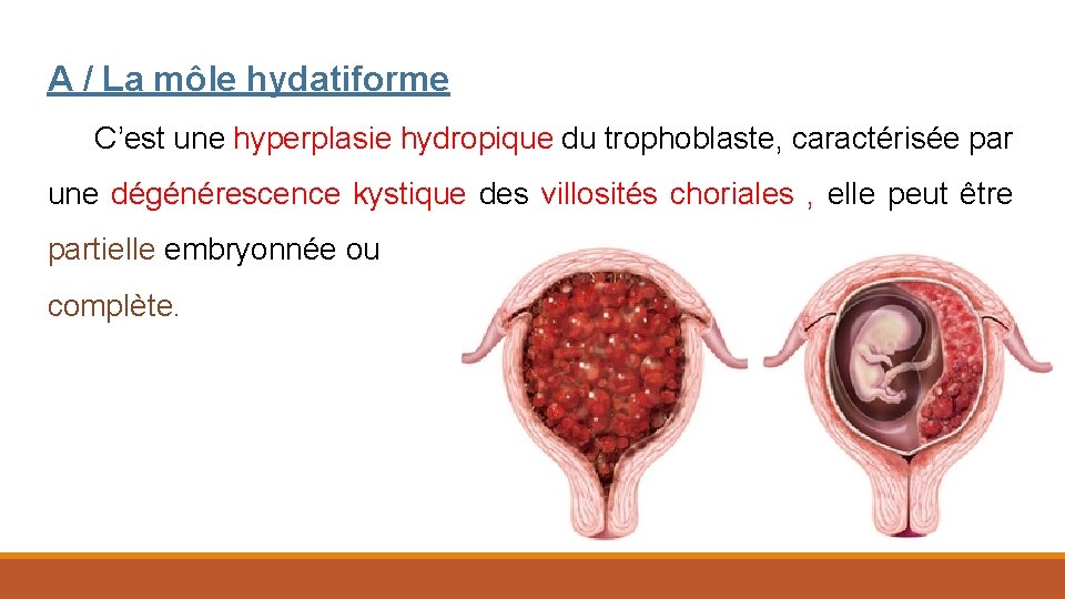 A / La môle hydatiforme C’est une hyperplasie hydropique du trophoblaste, caractérisée par une