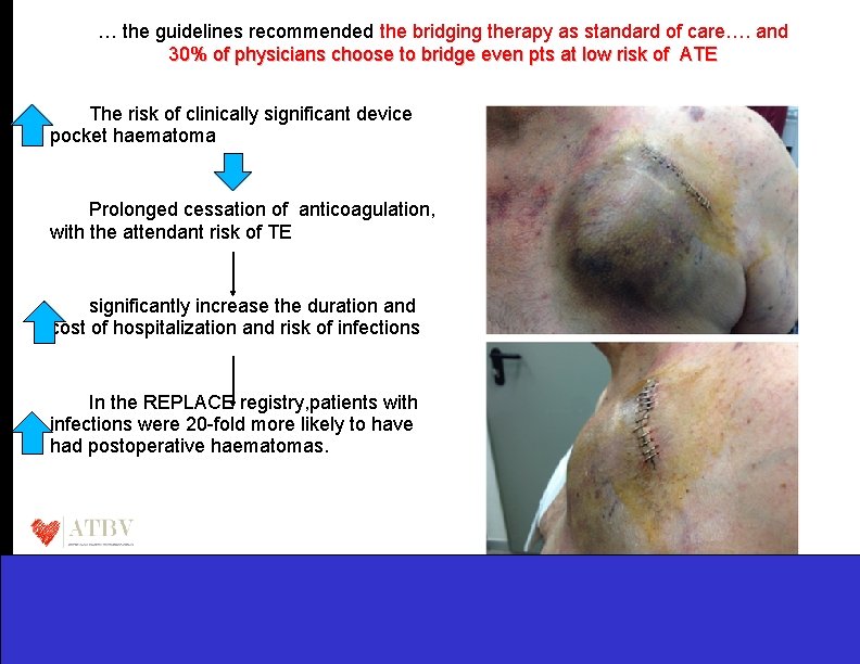 … the guidelines recommended the bridging therapy as standard of care…. and 30% of