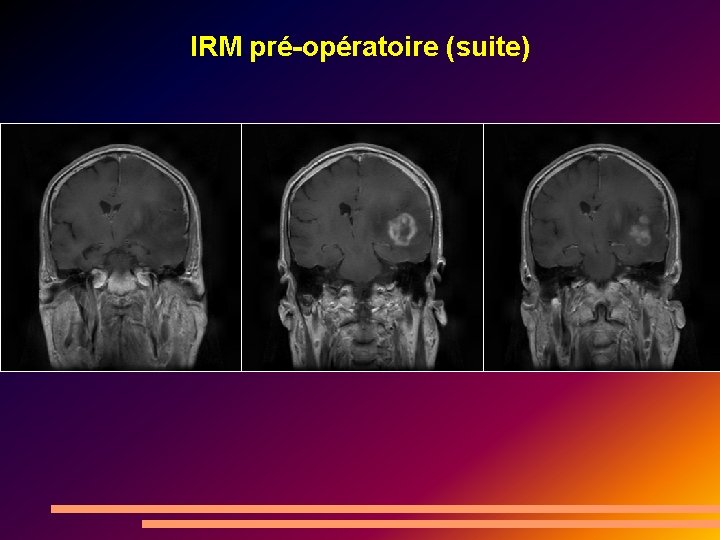 IRM pré-opératoire (suite) 