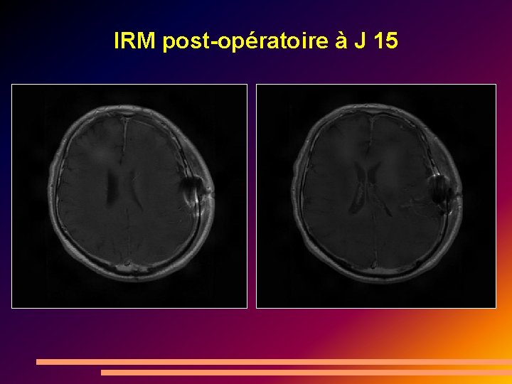 IRM post-opératoire à J 15 