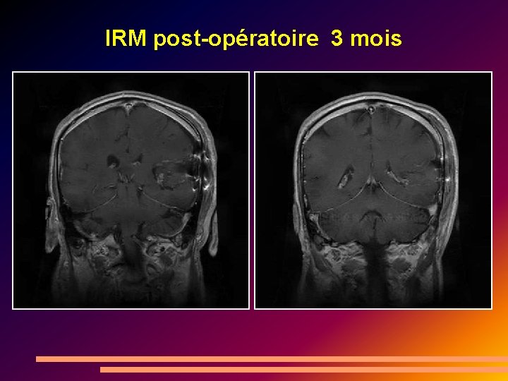 IRM post-opératoire 3 mois 