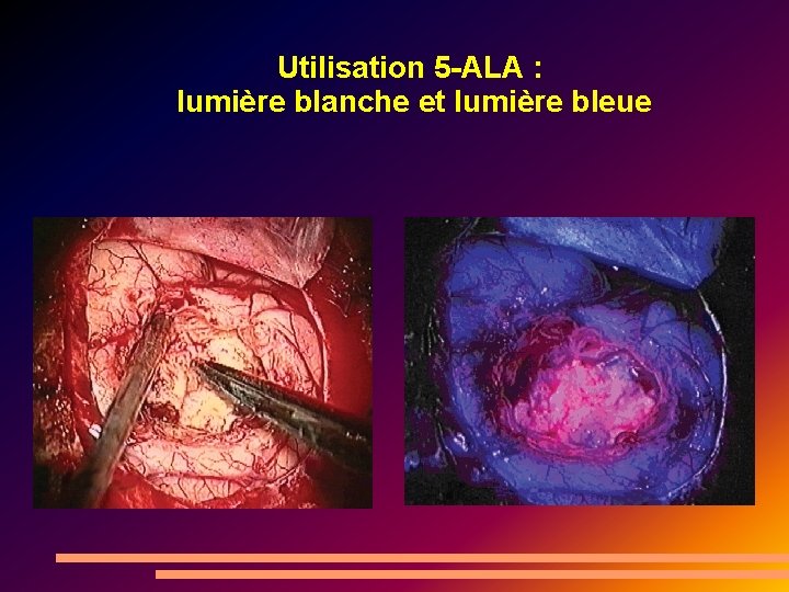 Utilisation 5 -ALA : lumière blanche et lumière bleue 