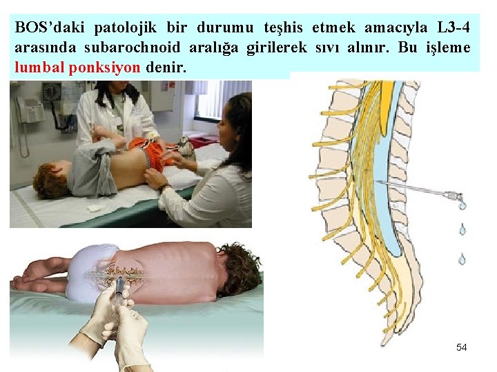 BOS’daki patolojik bir durumu teşhis etmek amacıyla L 3 -4 arasında subarochnoid aralığa girilerek