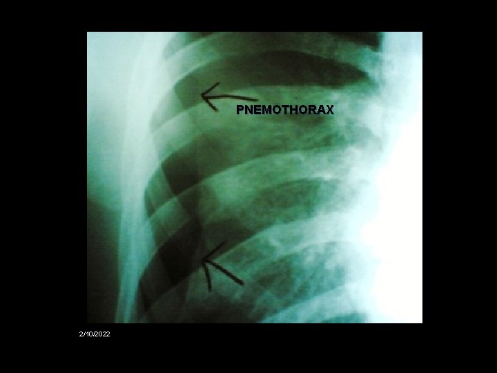 PNEMOTHORAX 2/10/2022 