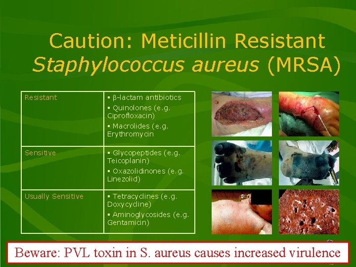 Caution: Meticillin Resistant Staphylococcus aureus (MRSA) Resistant § b-lactam antibiotics § Quinolones (e. g.