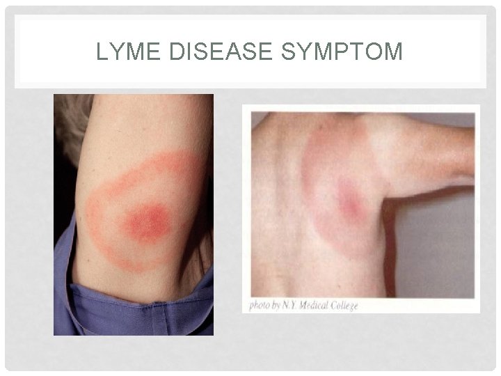 LYME DISEASE SYMPTOM 