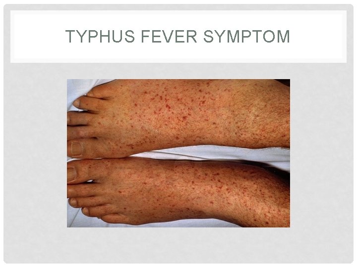 TYPHUS FEVER SYMPTOM 
