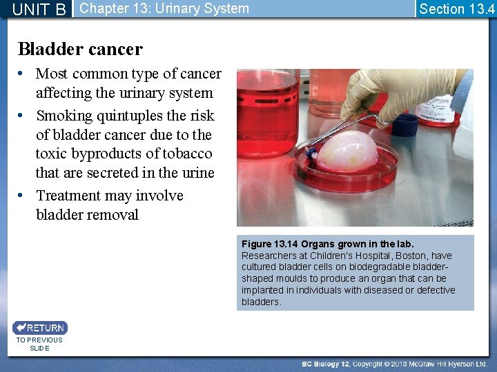 UNIT B Chapter 13: Urinary System Section 13. 4 Bladder cancer • Most common