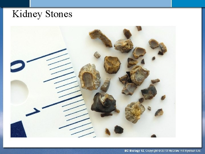 Kidney Stones 