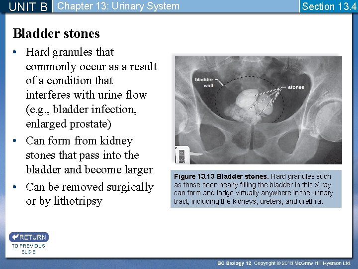 UNIT B Chapter 13: Urinary System Section 13. 4 Bladder stones • Hard granules