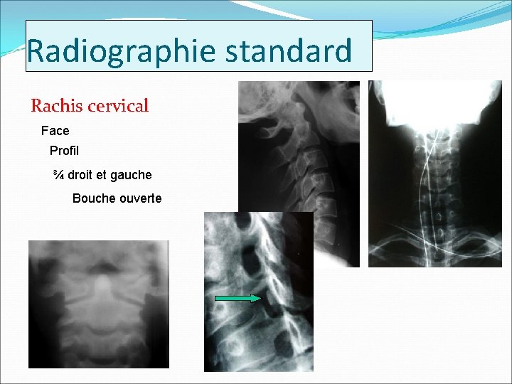 Radiographie standard Rachis cervical Face Profil ¾ droit et gauche Bouche ouverte 