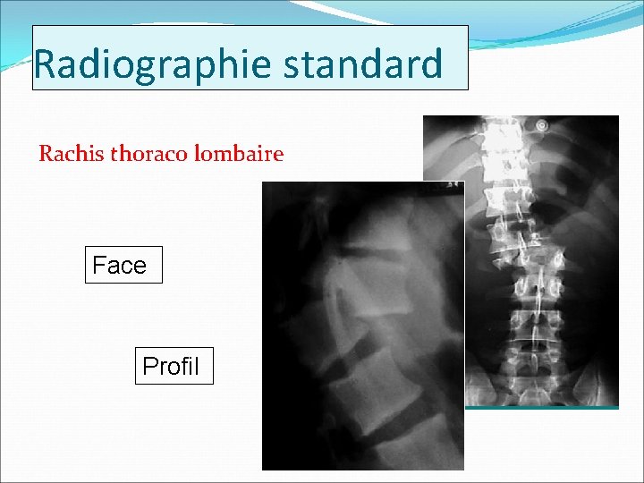 Radiographie standard Rachis thoraco lombaire Face Profil 