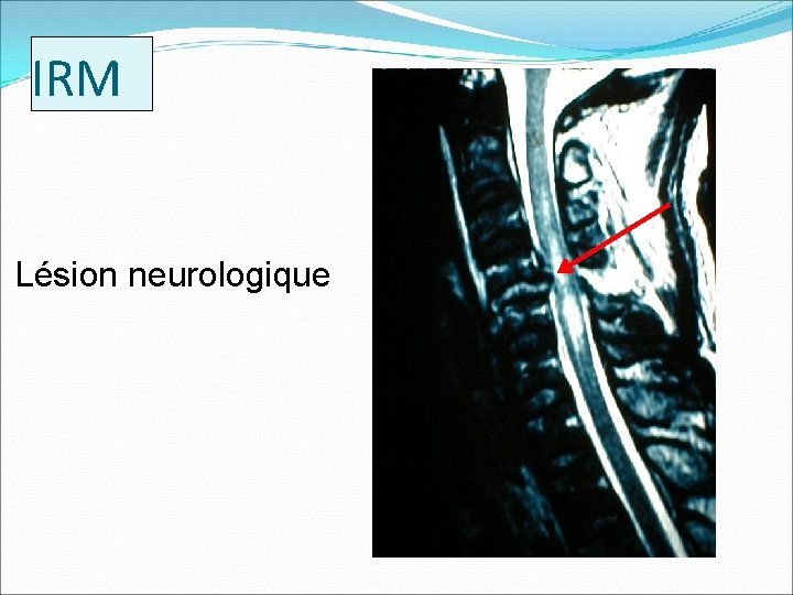 IRM Lésion neurologique 