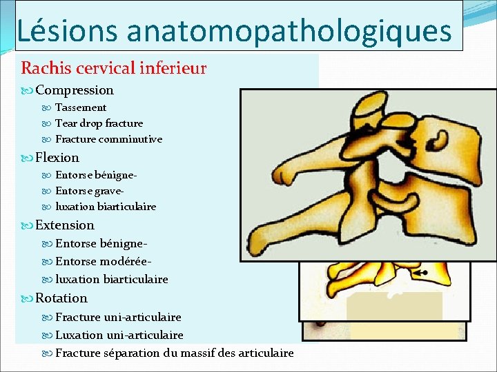 Lésions anatomopathologiques Rachis cervical inferieur Compression Tassement Tear drop fracture Fracture comminutive Flexion Entorse