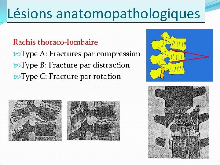 Lésions anatomopathologiques Rachis thoraco-lombaire Type A: Fractures par compression Type B: Fracture par distraction