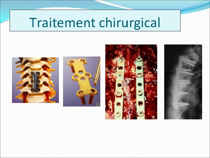 Traitement chirurgical 