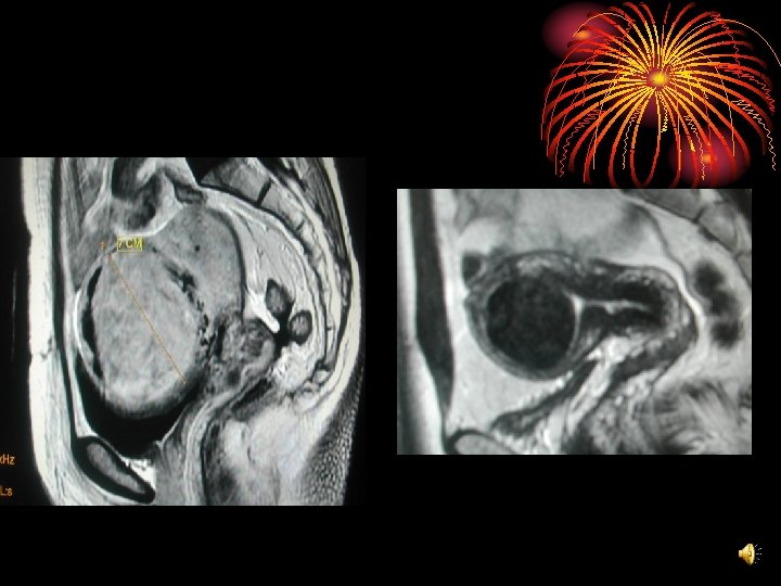 FIBROMES UTERINS PLACE DE LEMBOLISATION DR KUHL Radiologue