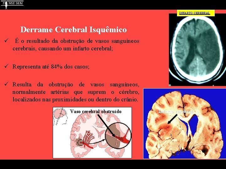 INFARTO CEREBRAL Derrame Cerebral Isquêmico ü É o resultado da obstrução de vasos sanguíneos