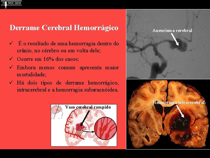 Derrame Cerebral Hemorrágico Aneurisma cerebral ü É o resultado de uma hemorragia dentro do