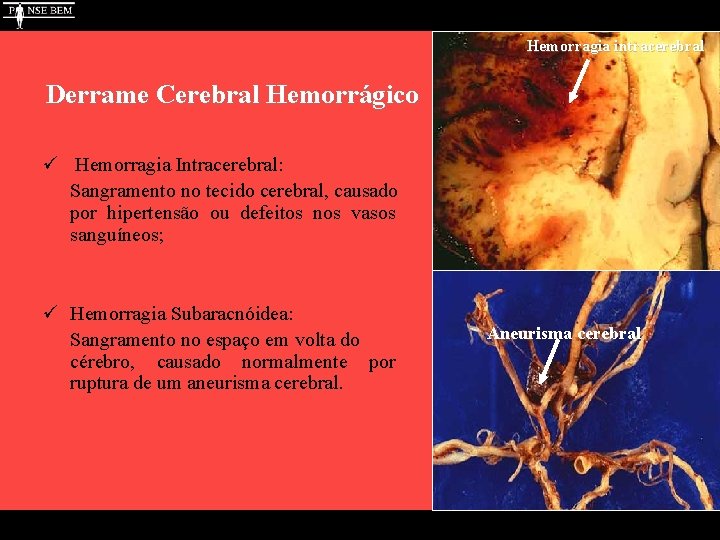 Hemorragia intracerebral Derrame Cerebral Hemorrágico ü Hemorragia Intracerebral: Sangramento no tecido cerebral, causado por