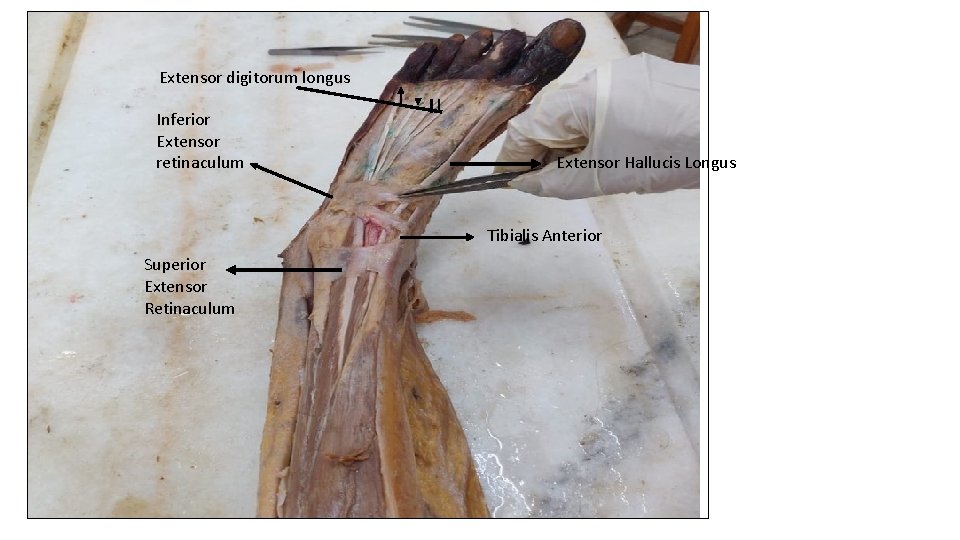 Extensor digitorum longus Inferior Extensor retinaculum Extensor Hallucis Longus Tibialis Anterior Superior Extensor Retinaculum