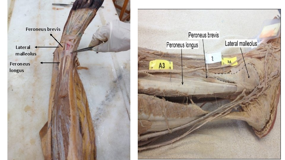 Peroneus brevis Lateral malleolus Peroneus longus 