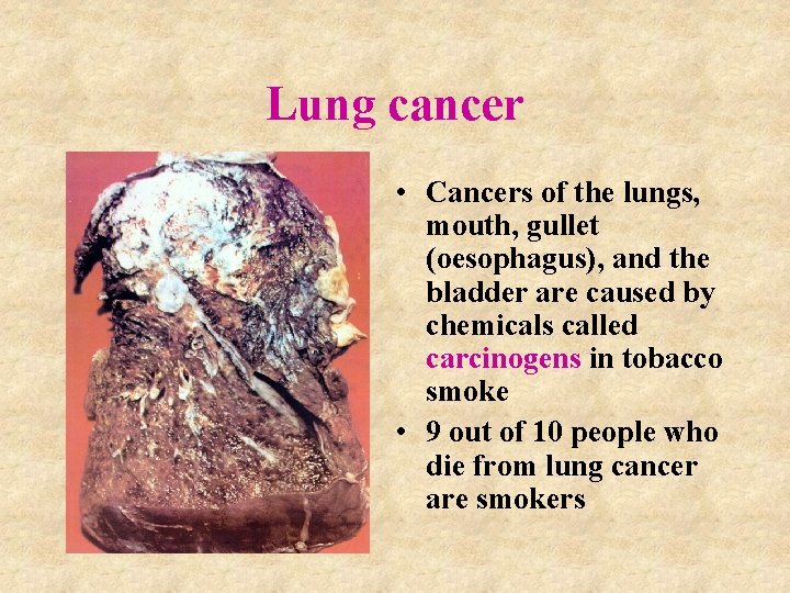 Lung cancer • Cancers of the lungs, mouth, gullet (oesophagus), and the bladder are