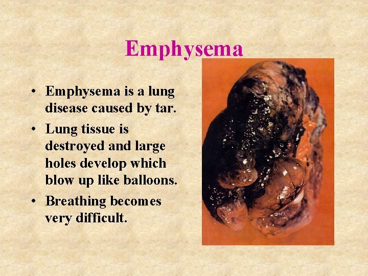 Emphysema • Emphysema is a lung disease caused by tar. • Lung tissue is