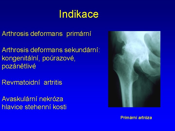 Indikace Arthrosis deformans primární Arthrosis deformans sekundární: kongenitální, poúrazové, pozánětlivé Revmatoidní artritis Avaskulární nekróza