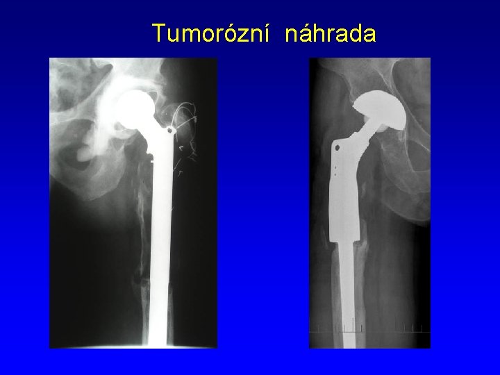 Tumorózní náhrada 